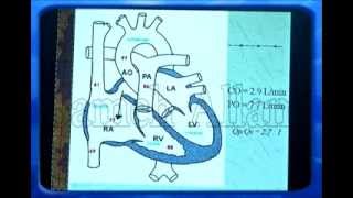 congenital heart disease ASD 1 [upl. by Ambie]