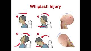 lecture 3 completion atlantoaxial  atlantooccipital joints   Hyoid bone [upl. by Loggins]