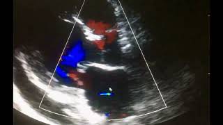 Ecocardiograma Complicaciones del Infarto al miocardio [upl. by Silletram952]