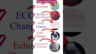 Heart attack cycle I हार्ट अटैक चकर ecg echo angiography shorts [upl. by Eiramik249]