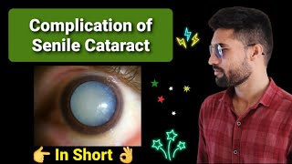 Complication of Senile Cataract lecture opthalmology [upl. by Ueih]