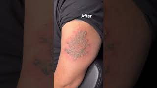 Laser Tattoo Removal before and after [upl. by Kim]