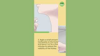 How To Remove a Hickey in Seconds with Toothpaste [upl. by Ahsirpac]