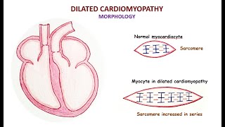 Dilated cardiomyopathy [upl. by Ralf]