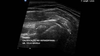 Ultrassom do Ombro  Tendinopatias e lesões do Infraespinhal [upl. by Soloman]