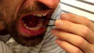 Removing my own salivary gland stone [upl. by Euqinorev]