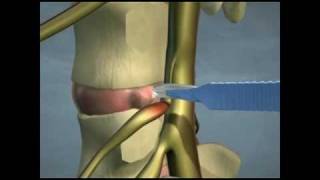 Lumbar Disc Herniations [upl. by Aubreir]