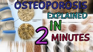 OSTEOPOROSIS  EXPLAINED IN 2 MINUTES  CAUSES  SYMPTOMS  TREATMENT  WHAT IS OSTEOPOROSIS [upl. by Gignac]