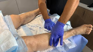 HOW TO REDUCE SWELLINGCOMPLICATIONS SCAR TISSUE AFTER LIPOSUCTION LYMPHATIC MASSAGEDr Jason Emer [upl. by Obmar33]