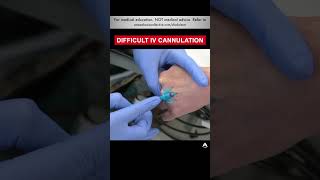 Difficult IV Cannulation  shorts ivcannulation anesthesiology nurse [upl. by Trillbee548]