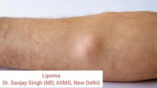 Lipoma  Introduction  Cause  Diagnosis  Treatment lipoma cancer skincancer skincaretips [upl. by Nivloc]