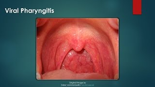 Viral Pharyngitis [upl. by Analise]