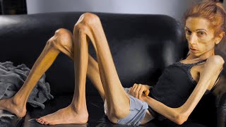 This Is the Thinnest Person In The World [upl. by Gensmer]