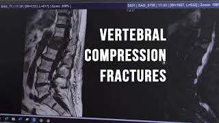 How to Identify Vertebral Compression Fractures [upl. by Aneroc530]