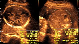 Ultrasound cases 442 of 2000  Anomaly study [upl. by Eillib]