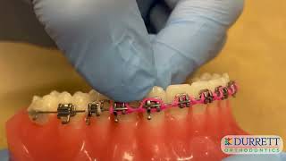 How to fix a poking quotpig tailquot wire connected to your braces [upl. by Pardoes]