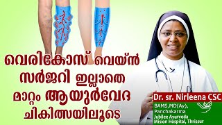 വെരികോസ് വെയ്ൻ സർജറി ഇല്ലാതെ മാറ്റം ആയുർവേദ ചികിത്സയിലൂടെ  Dr Sr Nirleena CSC ദേഹം ദേവാലയം Epi10 [upl. by Leod]