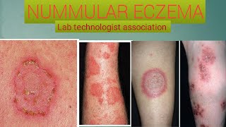 What is nummular eczema ans how to cure [upl. by Lisa909]