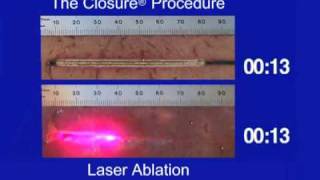 Tissue Thermal Ablation Pattern of ClosureFAST vs Laser [upl. by Ahsinnek630]