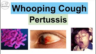 Whooping Cough Pertussis  Transmission Pathophysiology Symptoms Diagnosis Treatment [upl. by Lord]