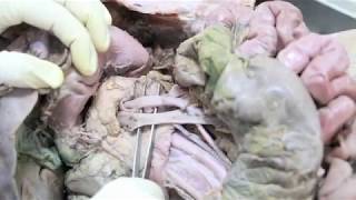 Anatomy Dissection of Pancreas amp Duodenum [upl. by Rekoob]