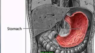 peptic ulcer disease in children [upl. by Ecirtram]