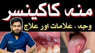 ORAL CANCER  Symptoms  Causes  Treatment  منہ کا کینسر  Urdu  Hindidrmuneermalik [upl. by Gemina]