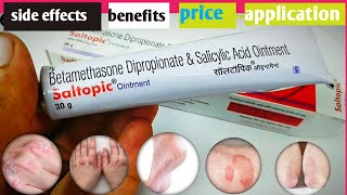 Saltopic Ointment  Betamethasone Dipropionate amp Salicylic Acid Ointment  Saltopic psoriasis [upl. by Ave769]