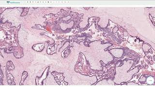 Complete Hydatidiform Mole  Histopathology [upl. by Lenod]