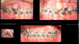 Orthodontic Treatment  Class III  Time Lapse [upl. by Caron]