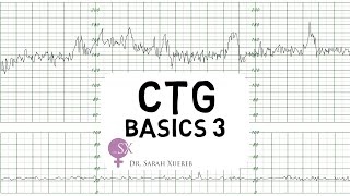 CTG Basics Part 3  Overall Assessment amp Examples [upl. by Gisella591]