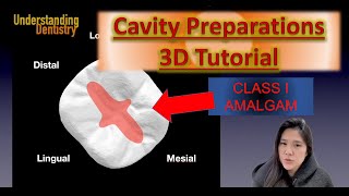 EASY Dental Cavity Preparation 3D TUTORIAL and Step by Step Guide Class I Amalgam Class 1 [upl. by Ilene764]