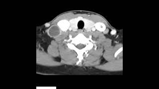 Tbc ganglionar cervical [upl. by Gile]