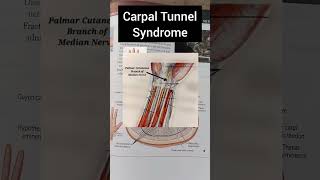 Carpal Tunnel Syndrome [upl. by Ardnoek]