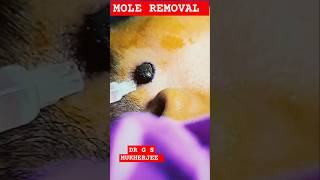 Mole removal shorts viral moleremoval drgsmukherjee moleremove trending dermatologist [upl. by Aphrodite]