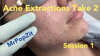 Acne extractions take 2 session 1 Blackheads whiteheads Ears 20 minutes of just the pop ASMR [upl. by Ekaterina712]