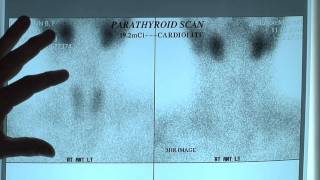 What are Sestamibi Scans Positive amp Negative Sestamibi Parathyroid Scans [upl. by Theodora]