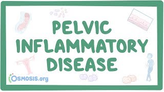 Pelvic inflammatory disease  causes symptoms diagnosis treatment pathology [upl. by Adehsor235]