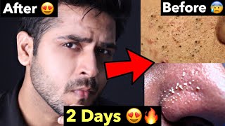 How to Remove Blackheads Whiteheads Naturally  Tips To Remove Whiteheads Blackheads From FACE [upl. by Errick808]