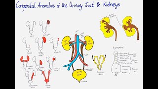 congenital anomalies of the urinary tract and kidneys [upl. by Siouxie]