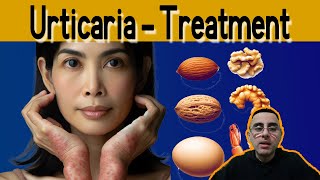 Urticaria Hives Symptoms causes treatment Prevention [upl. by Eimam]