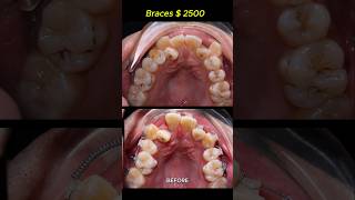 Cost  2500 for this case Braces crooked teeth braces orthodontist dentist [upl. by Yauq514]