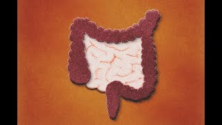 Patología Isquémica Intestinal Definición Evaluación Tratamiento [upl. by Alda]