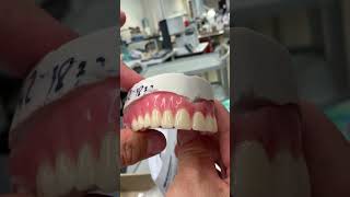 Upper Denture that clasps to one Tooth [upl. by Hakym]