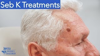 Seborrheic Keratosis Treatment amp Removal Liquid Nitrogen amp Curetagge [upl. by Nodyarg59]