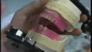 Mounting Anterior Teeth Part 4 [upl. by Nnayd434]