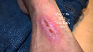 Progressive wound healing [upl. by Dwayne329]