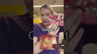 Overjet vs overbite braces overbite overjet [upl. by Nnyleitak]