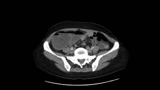 Colon adenocarcinoma [upl. by Elacim]