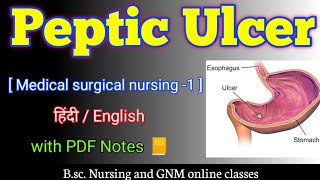 Peptic ulcers bsc nursing 2nd year  Peptic ulcer in hindi  Peptic ulcer medical surgical nursing [upl. by Rempe561]